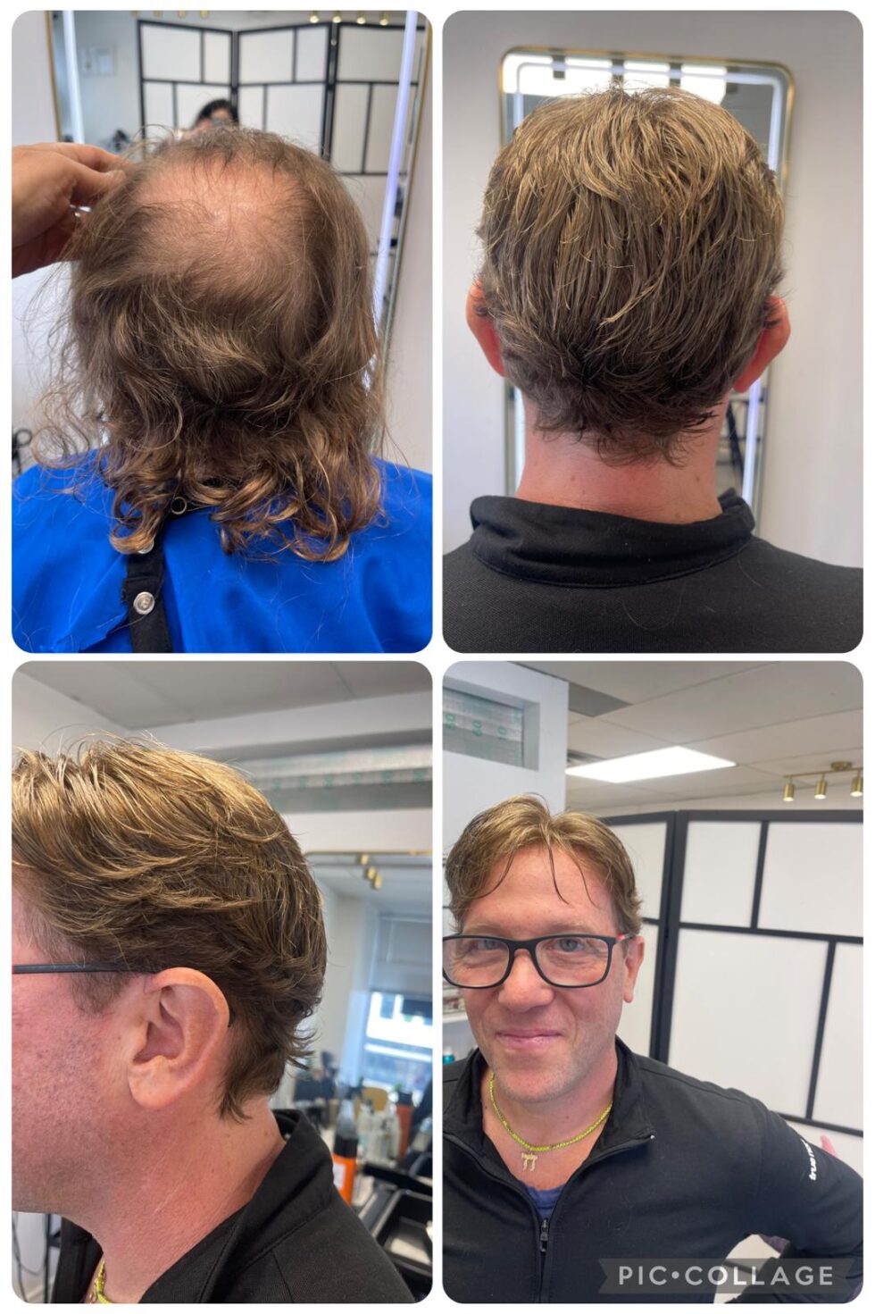 Hair Replacement in Toronto: What to Know Before You Buy Online