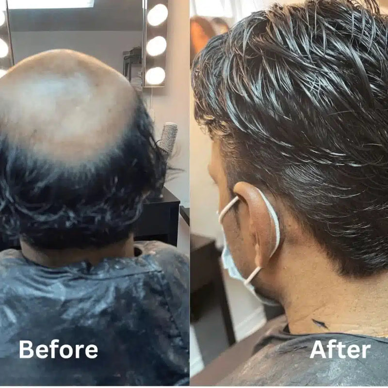 Before and after hair replacement system result, Biro Hair Replacement Toronto