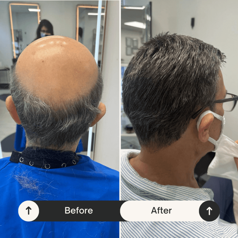 Before and after hair replacement system result, Biro Hair Replacement Toronto