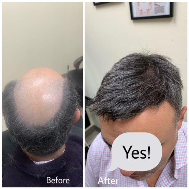 Before and after hair replacement system result, Biro Hair Replacement Toronto