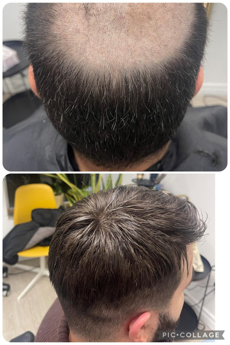 Before and after hair replacement system result, Biro Hair Replacement Toronto