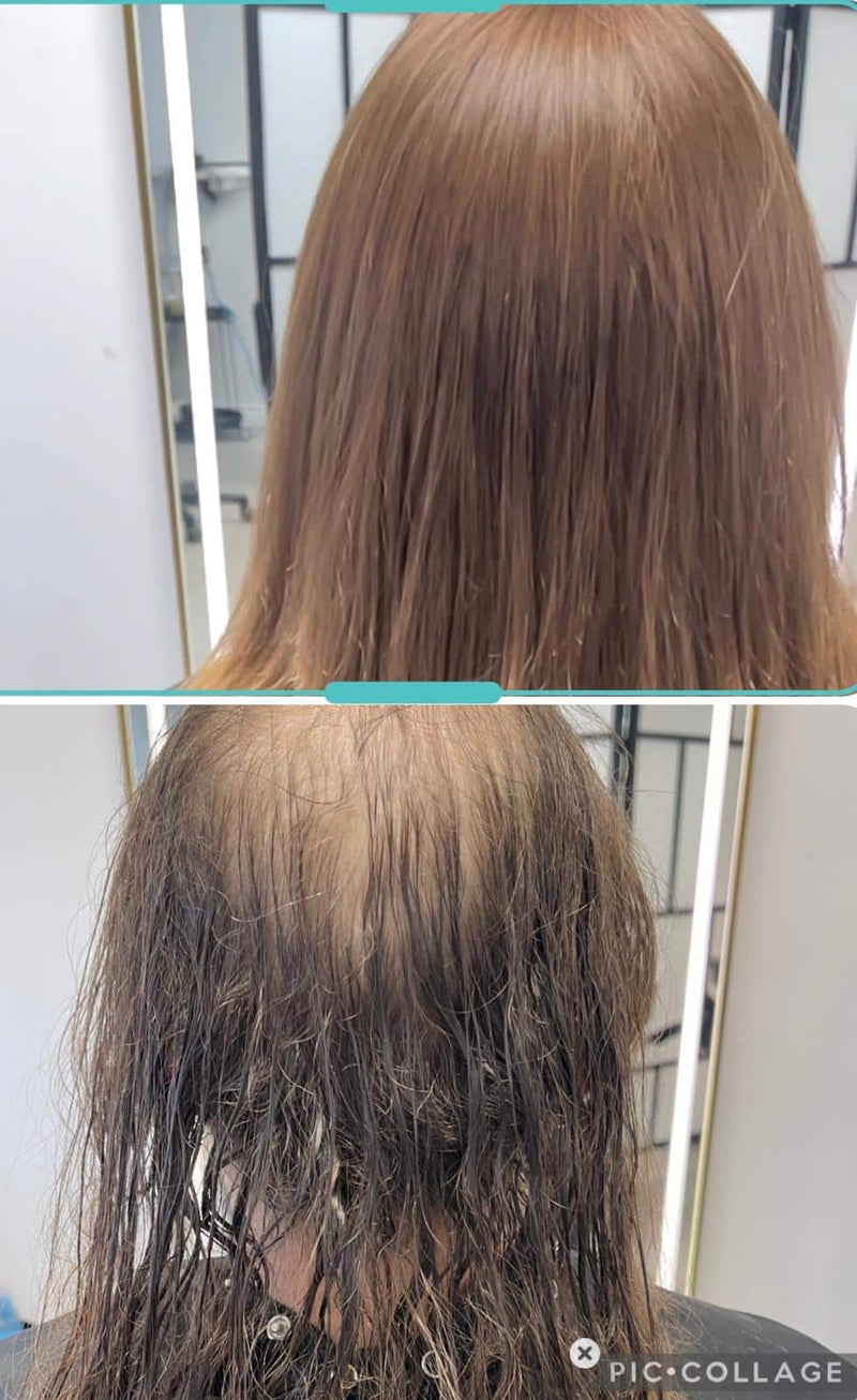Before and after hair replacement system result, Biro Hair Replacement Toronto