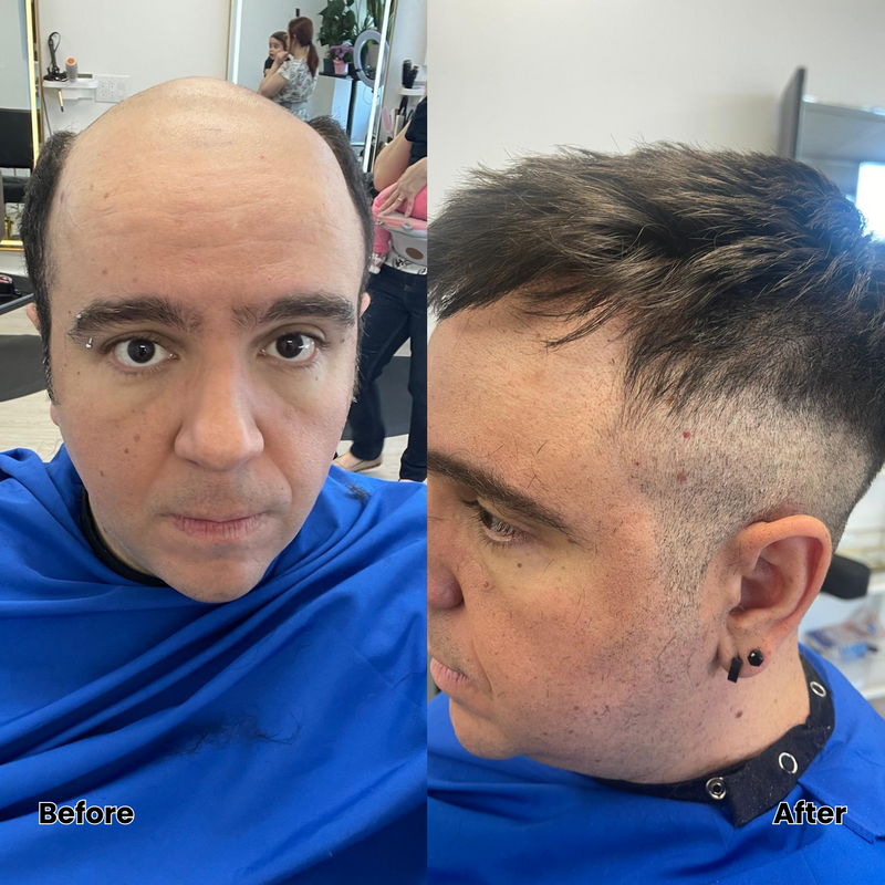 Before and after hair replacement system result, Biro Hair Replacement Toronto